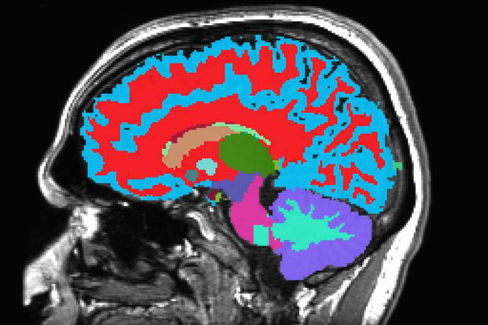 MRI image of the brain.
